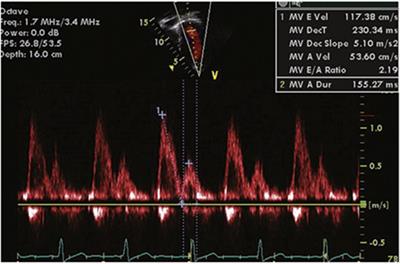 Assessment of Diastolic Function in Congenital Heart Disease